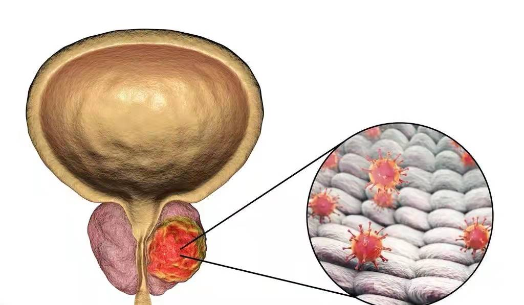 前列腺钙化是怎么回事?