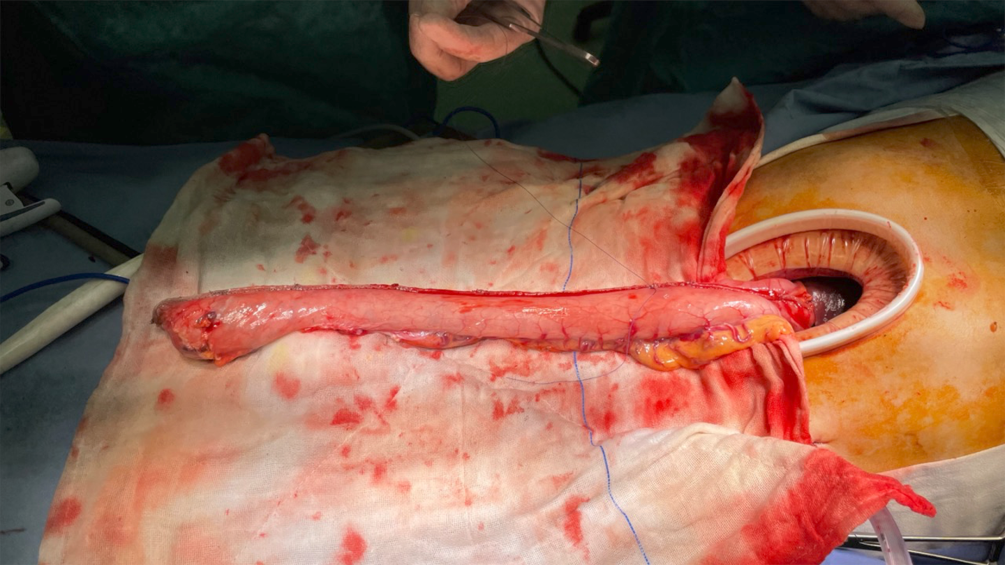 食管癌案例分享:新辅助化免 微创mckeown手术 选择性右颈淋巴结清扫