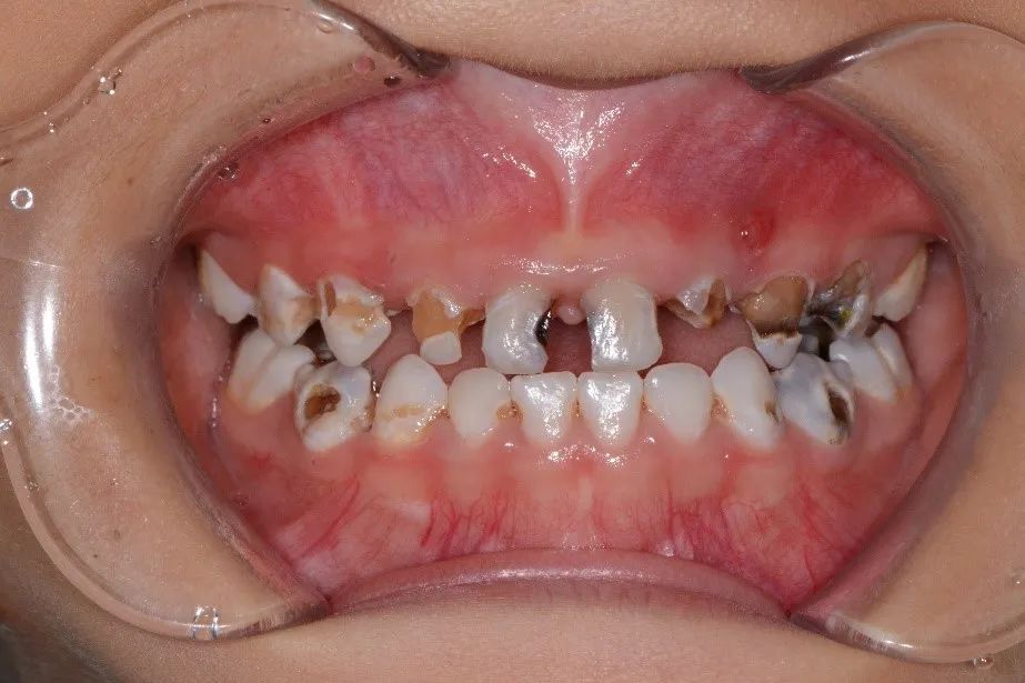 色素沉着(牙体完整,表面着色)如何区分牙面黑色素沉积和蛀牙(龋齿)?