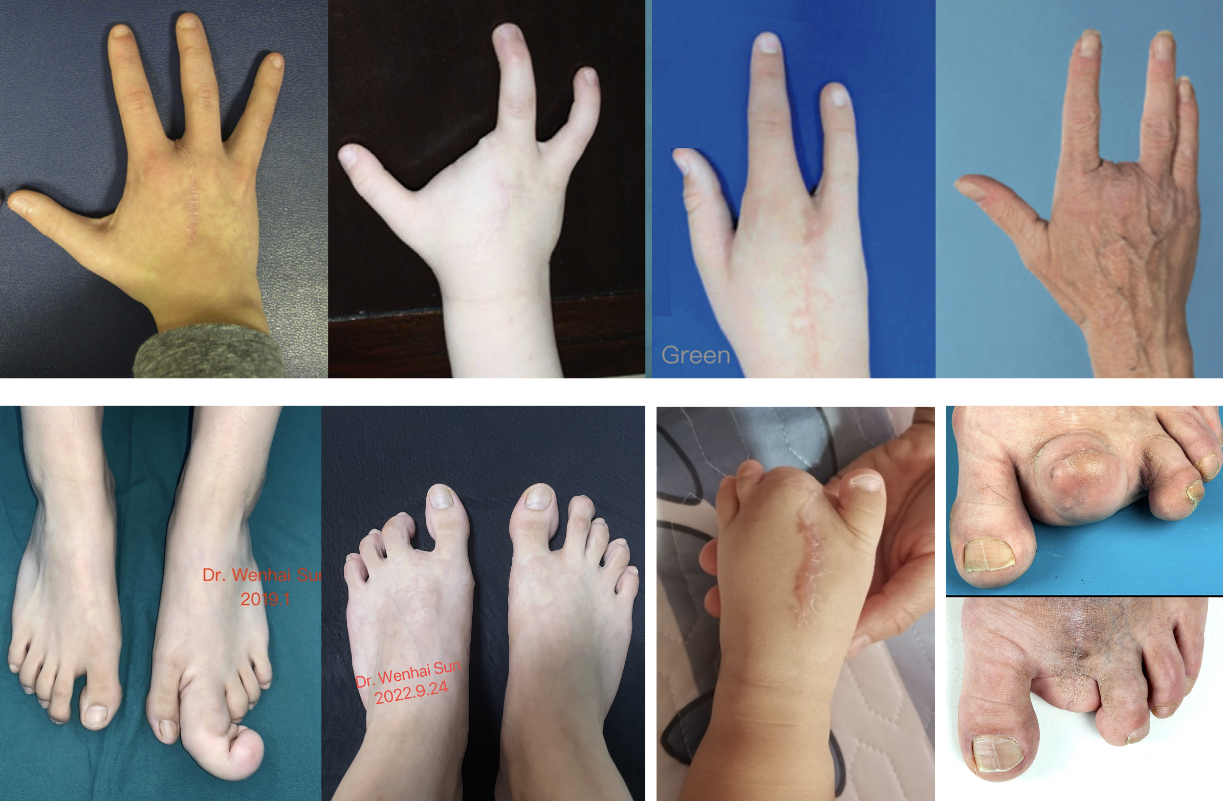 从美学考虑,保留4个足趾手指时手足仍有较自然正常的外形,但3个时明显