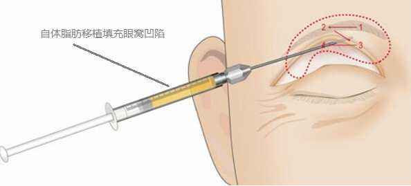 （图三）脂肪是通过注射的方式移植到缺失的眼眶部位