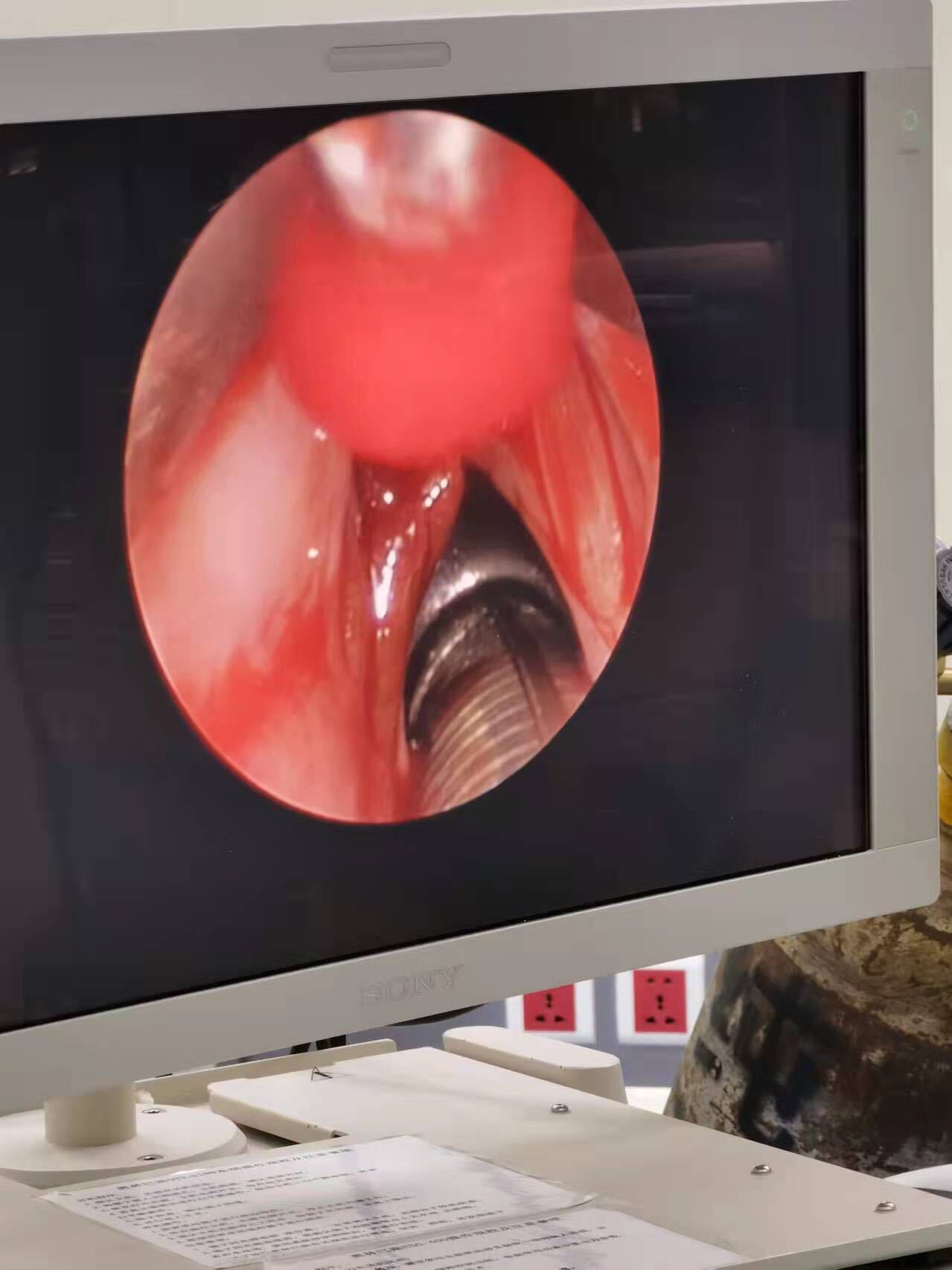 一例巨大出血性声带息肉经过全麻下支撑喉镜微创手术的精准性治疗