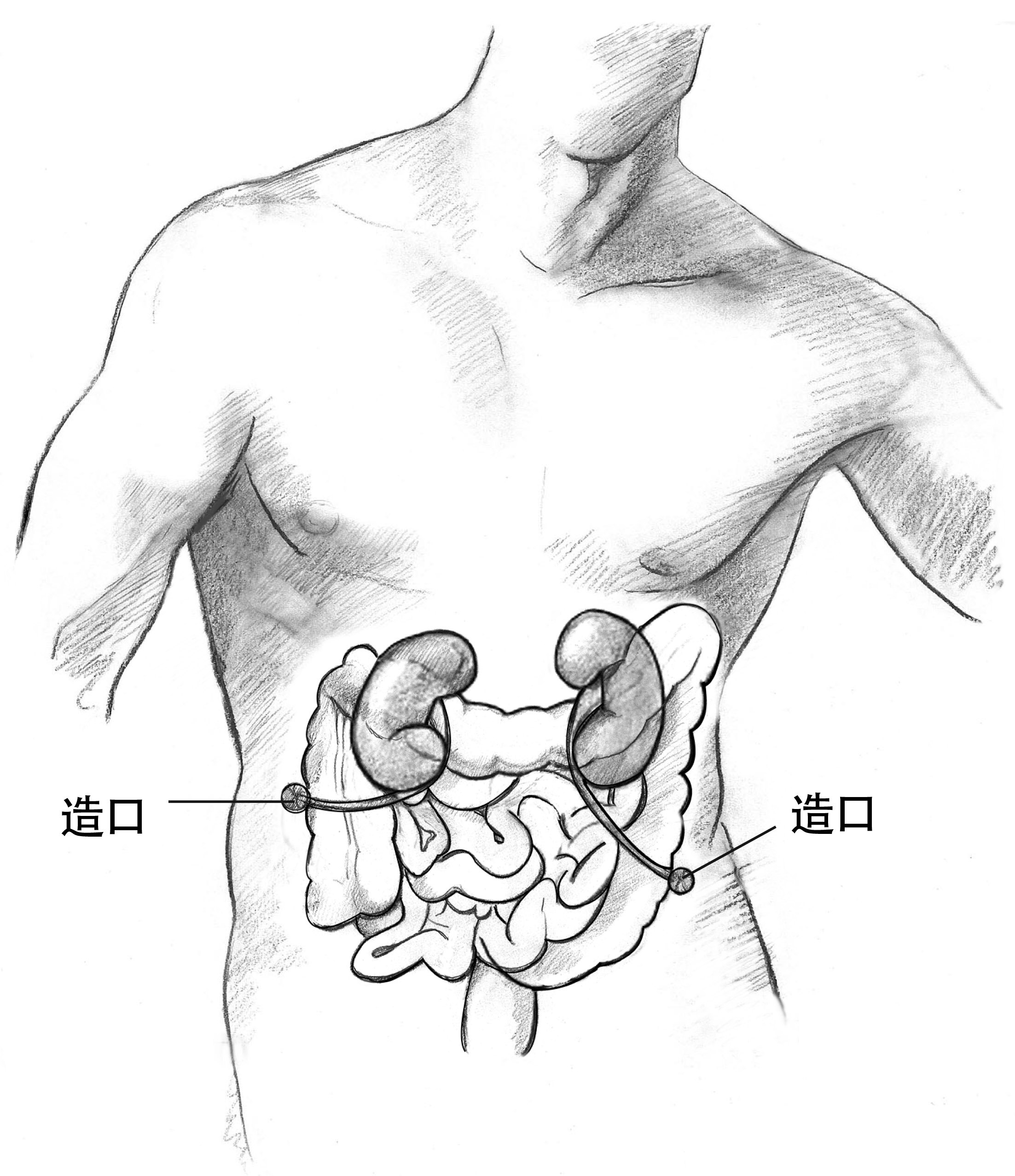 膀胱造口正常的图片图片