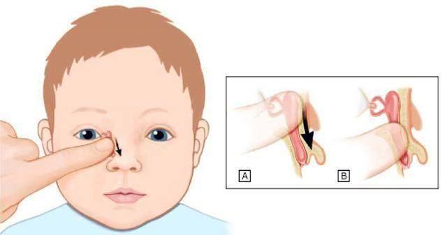 19-小婴儿总是流眼泪,咋回事儿?