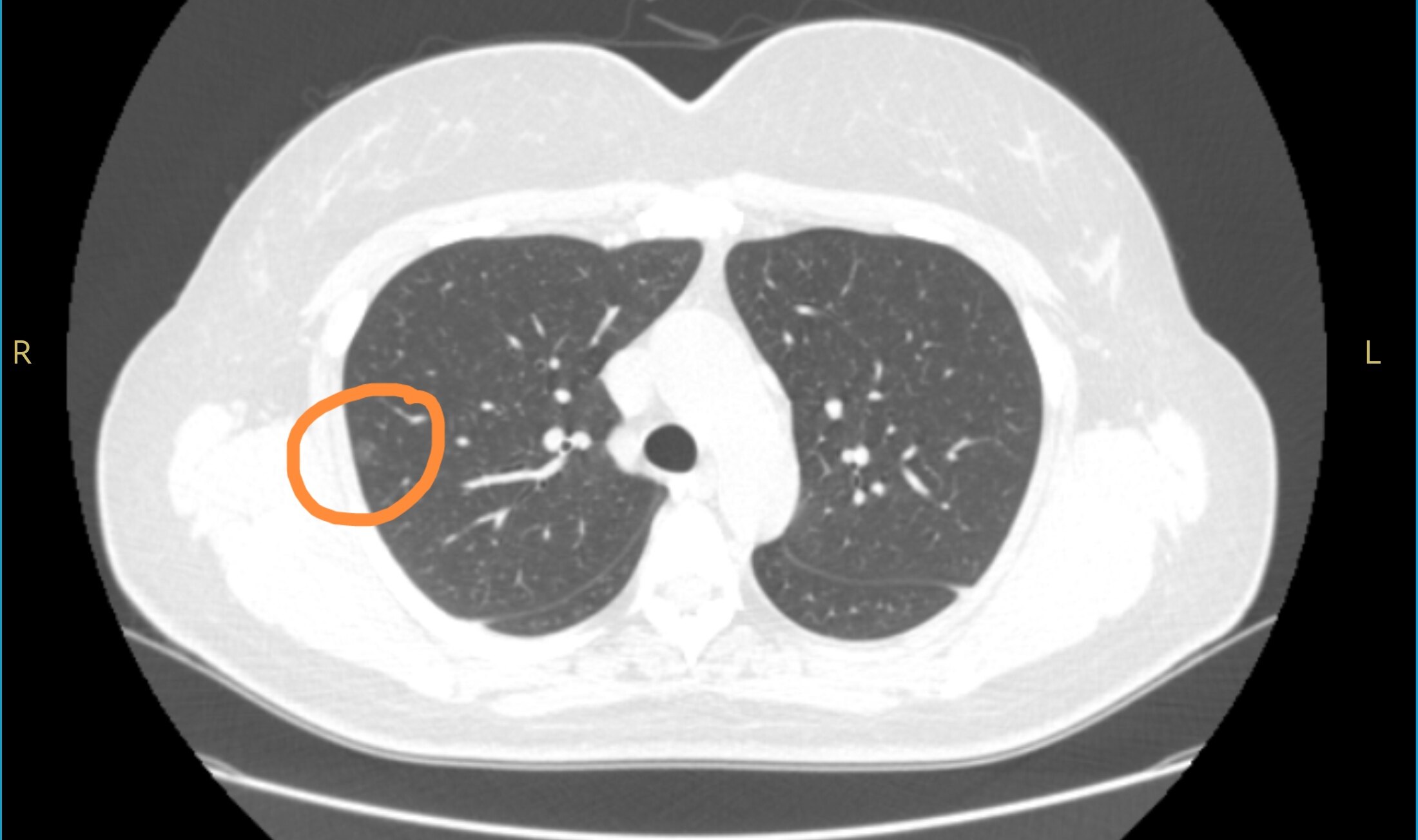 癌胚抗原高是什么肺癌 1oYBAGNb3uCASr9kAAK1RqIFAcU878.jpg?_ms_=5a21