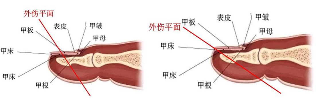 指端掌侧缺损.jpg