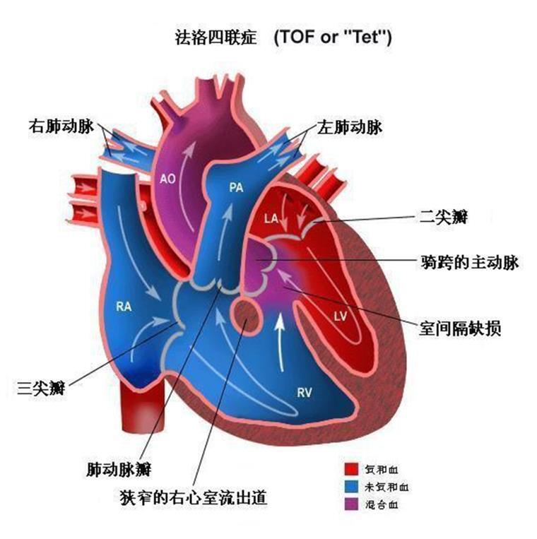 紫绀型先天性心脏病图片