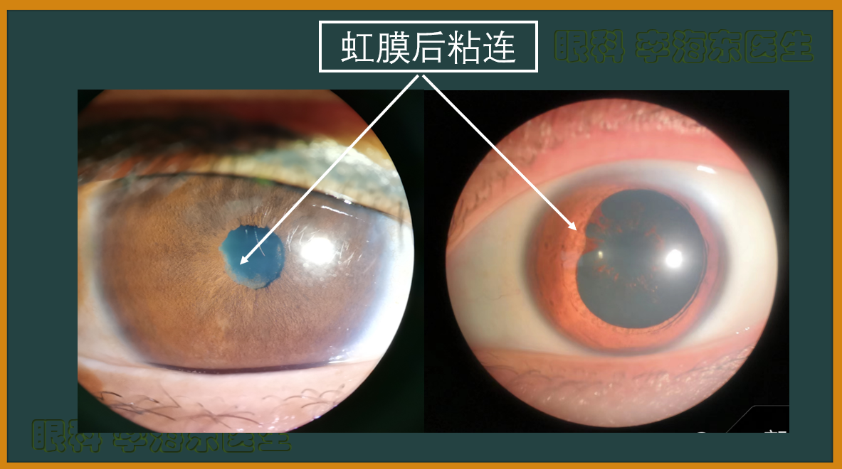 4,虹膜后粘连.png