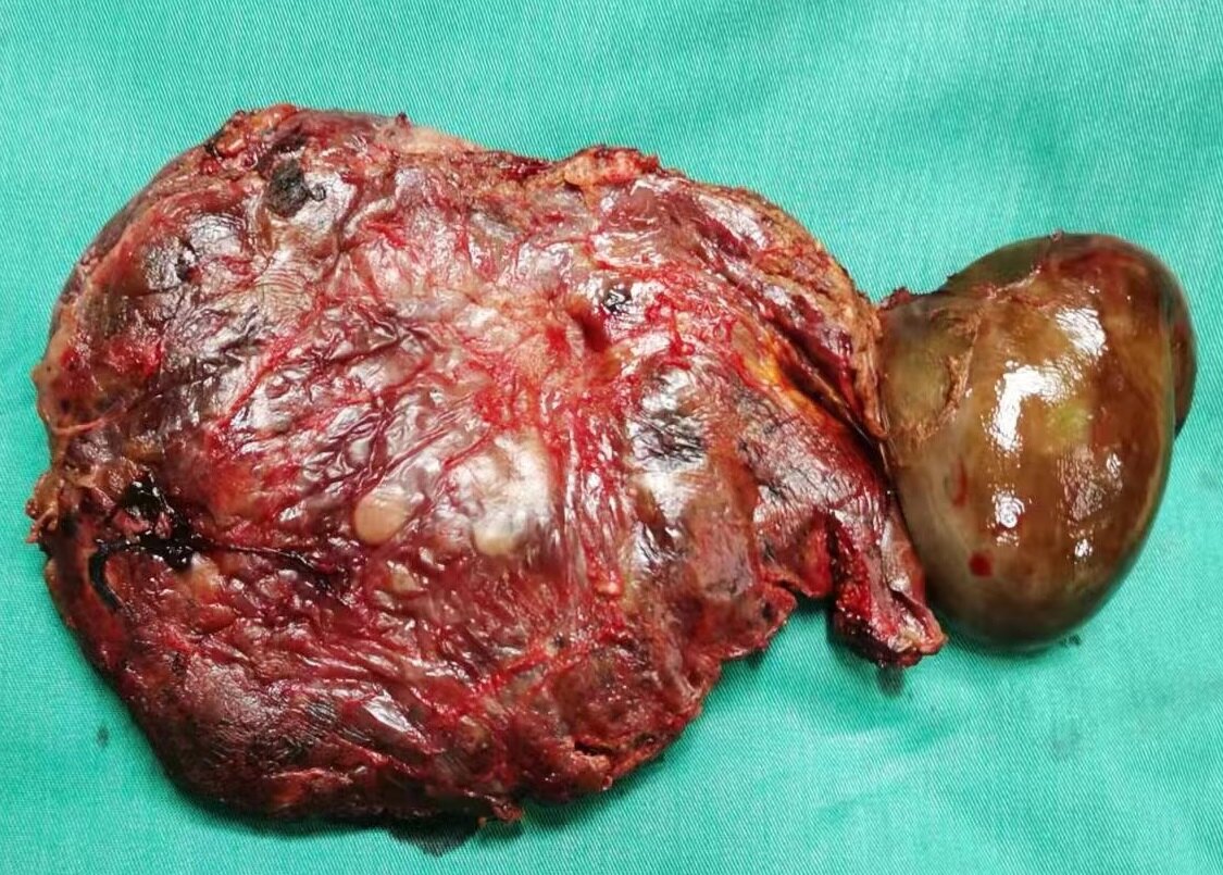 肝血管瘤图片危险图片