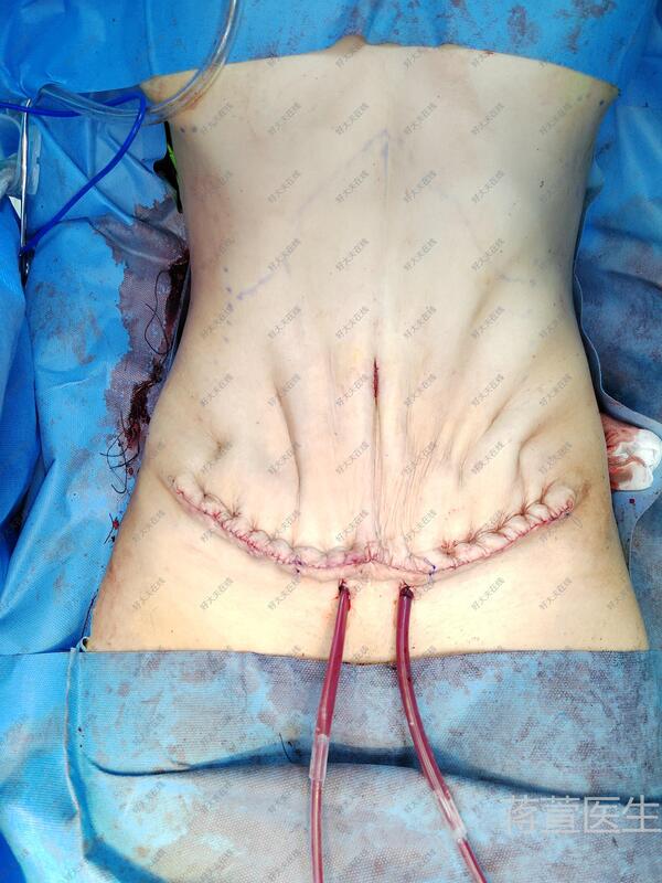 腹壁整形术前后效果图图片