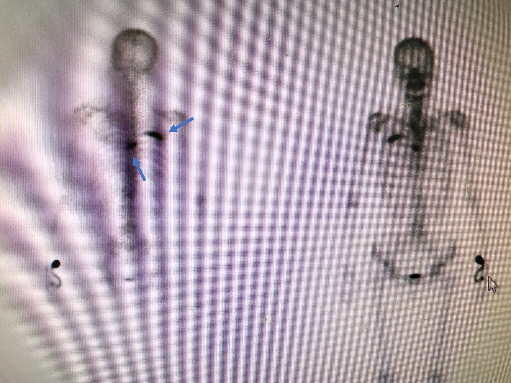 骨扫描提示多发骨转移(箭头所示)箭头所示纵隔淋巴结肿大,首先考虑