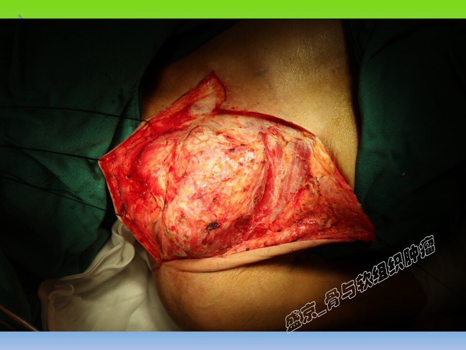 胸锁关节肿瘤图片