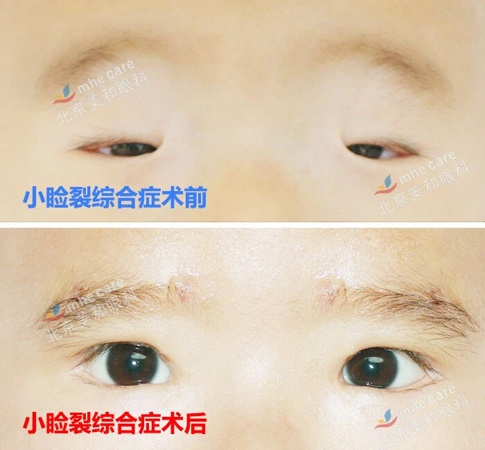 我们解决了低龄儿童的上睑下垂早期手术问题,但是术后护理家长却反映