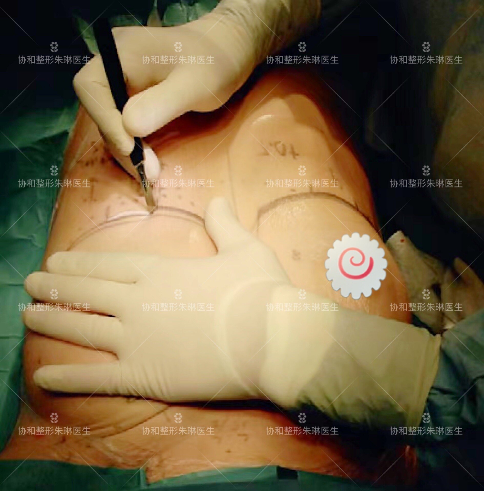 隆胸手术教程图片
