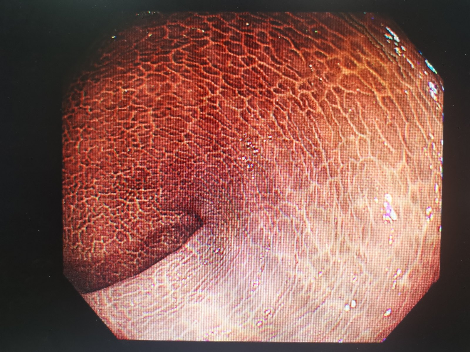 可怕的结肠黑变病_肠疾病_肠疾病相关疾病 - 好大夫在线