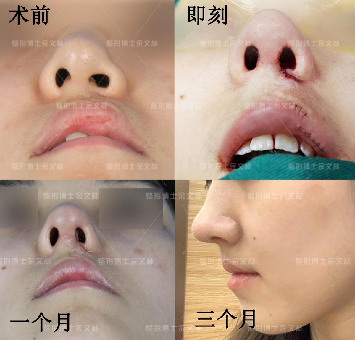 Nat Commun：口腔专家新发现 14 个唇腭裂易感基因 - 医疗健康专区 - 生物谷