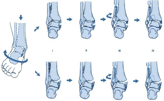 踝关节骨折lauge-hansen 分型 - 好大夫在线