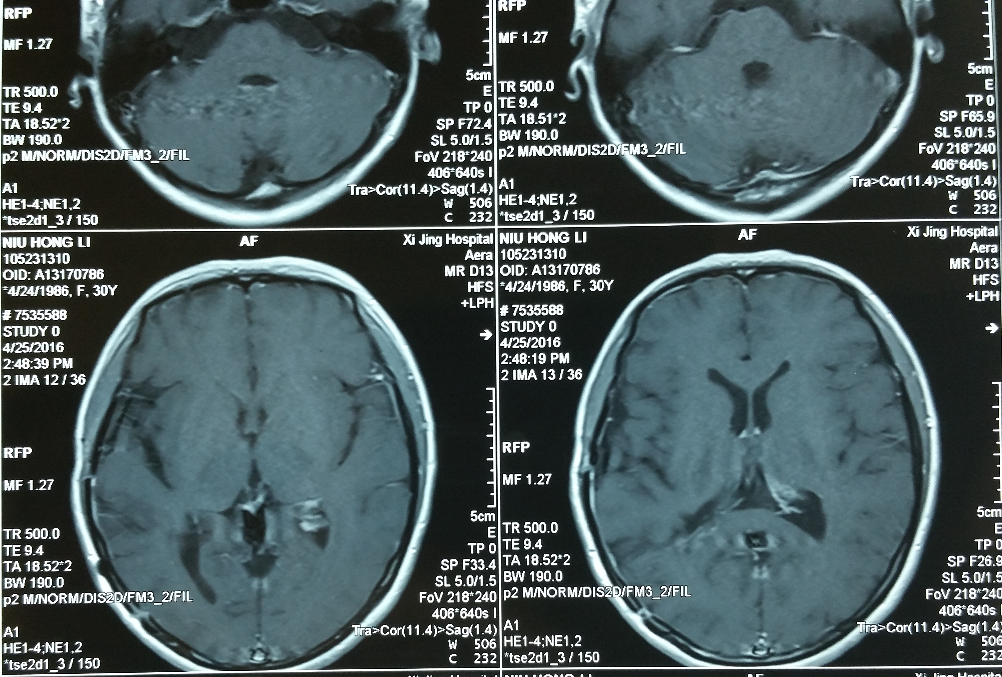 賀曉生教授手術患者追蹤腦膜瘤治療