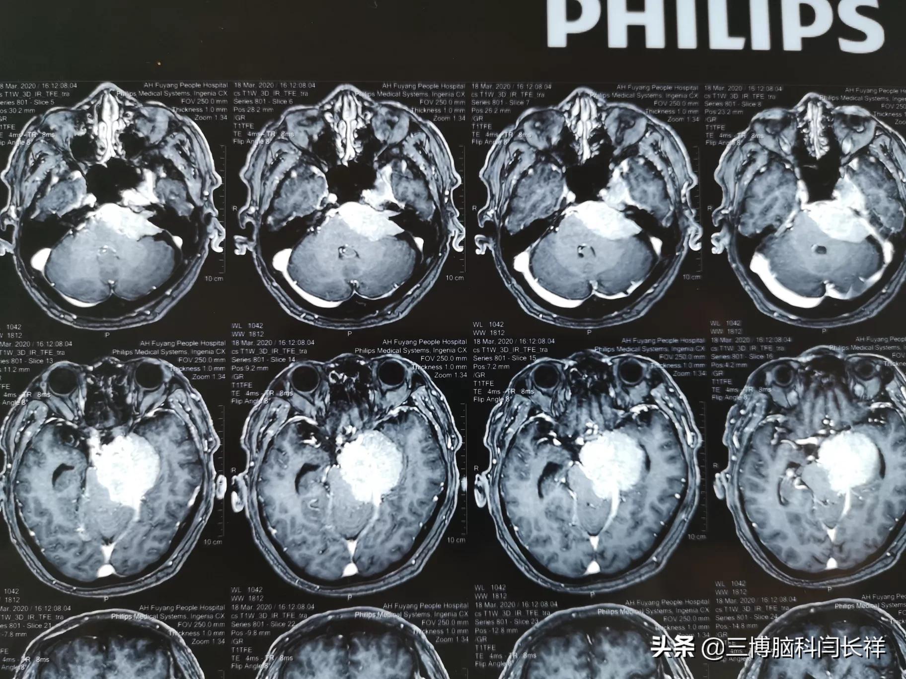 没有任何症状的脑膜瘤需不需要治疗_脑膜瘤 - 好大夫在线