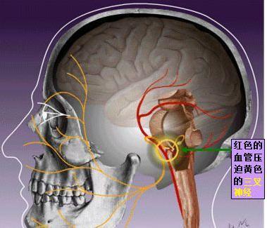 双侧<!--HAODF:8:sanchashenjingtong--><!--HAODF:8:sanchashenjingtong-->三叉神经痛<!--HAODF:/8:sanchashenjingtong--><!--HAODF:/8:sanchashenjingtong-->，微血管减压显良效