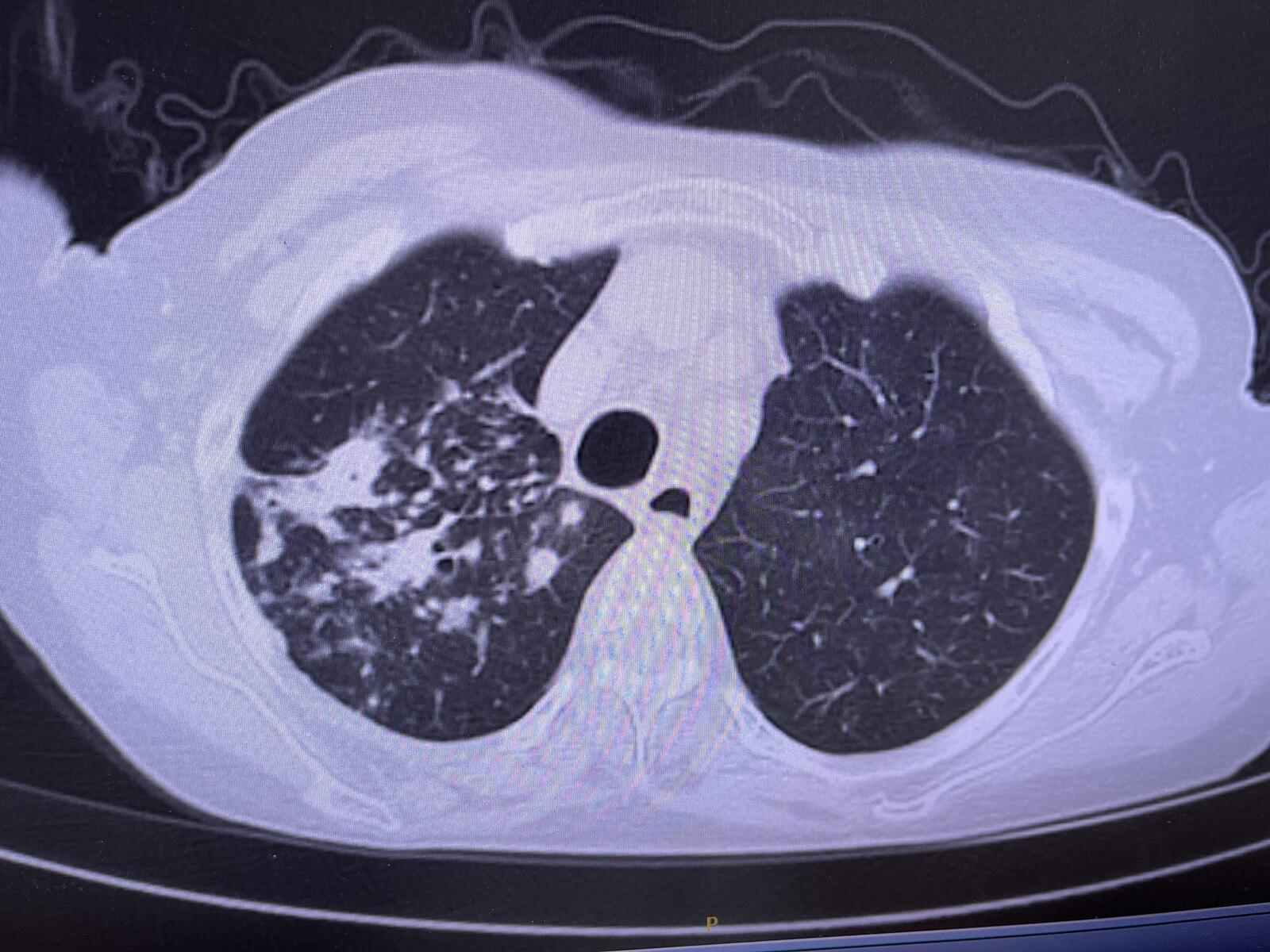 肺结核典型影像学