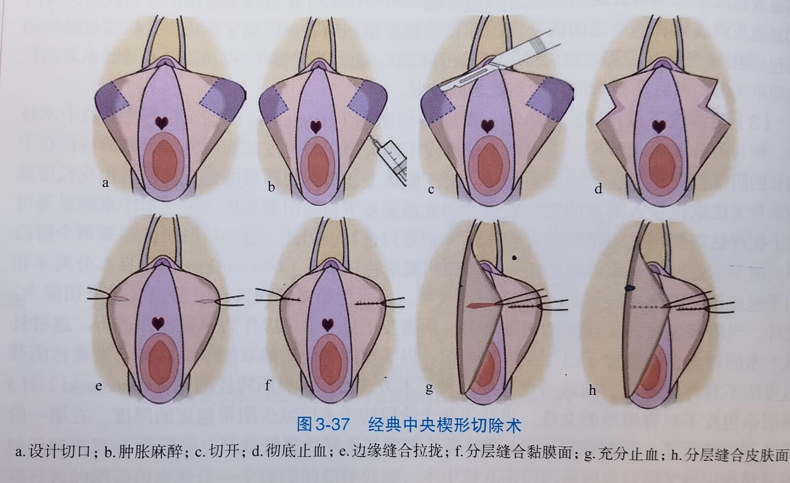 小阴唇 小阴唇缩小年轻化的三种手术方式——小阴唇楔形切除术_外阴整形_外阴整形治疗介绍- 好大夫在线