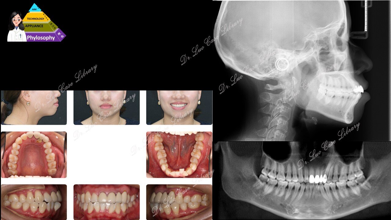 突面矯正拔牙矯正骨性齙牙矯正隱適美隱形矯正