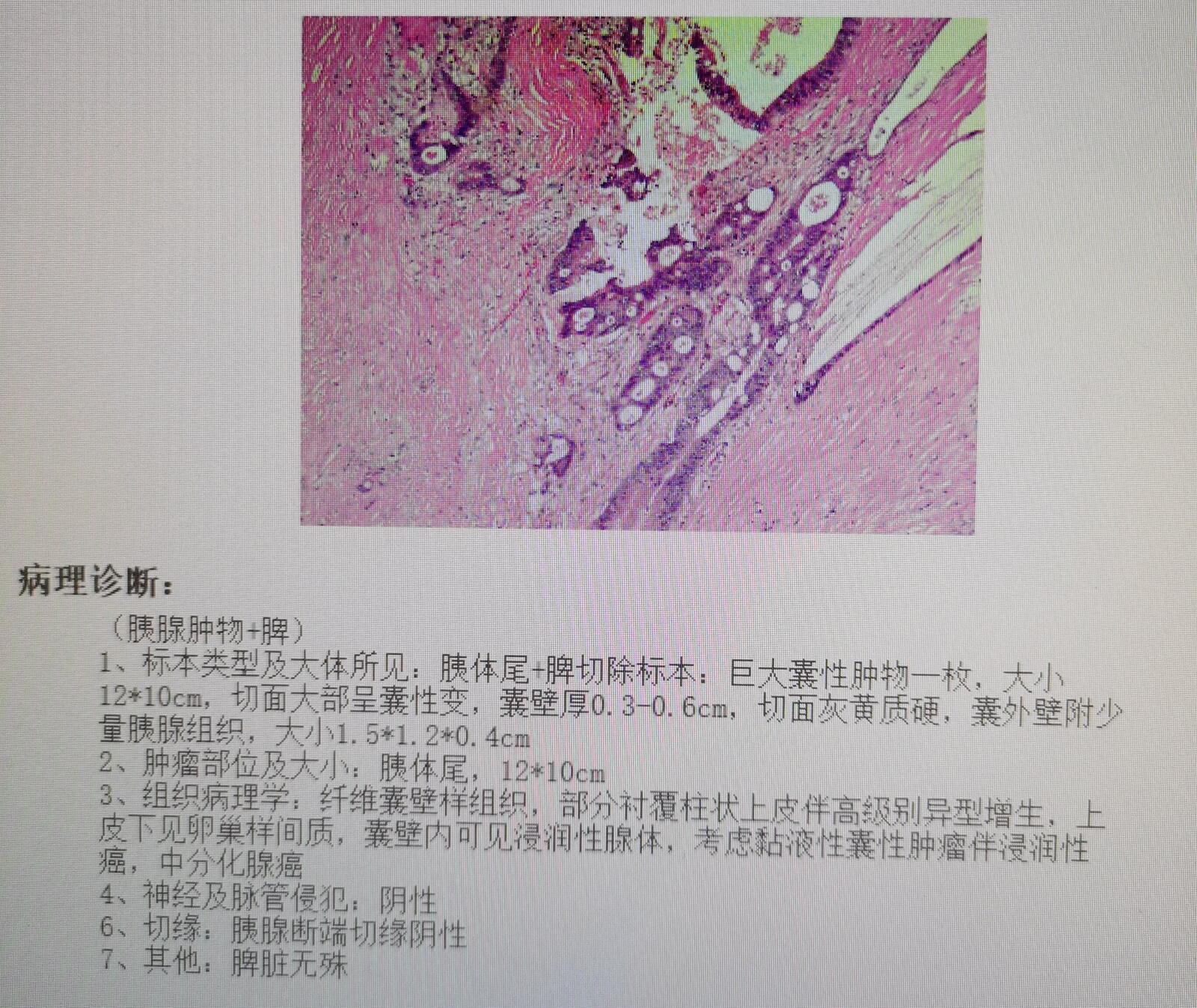 胰腺粘液性囊腺瘤癌變