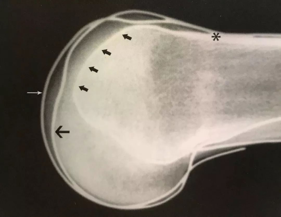 髌骨脱位最常见的解剖异常——滑车发育不良 - 好大夫在线