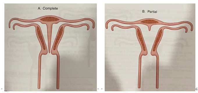 子宮裡多了一堵牆—縱膈子宮_子宮縱膈_治療方式_介紹_症狀表現 - 好