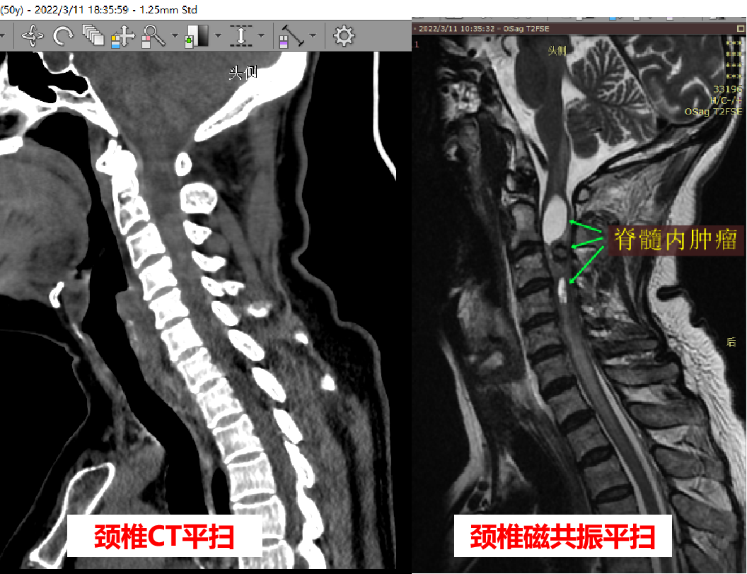 真正的颈椎病:必须颈椎磁共振证实:椎间盘突出压迫脊髓,可以解释的