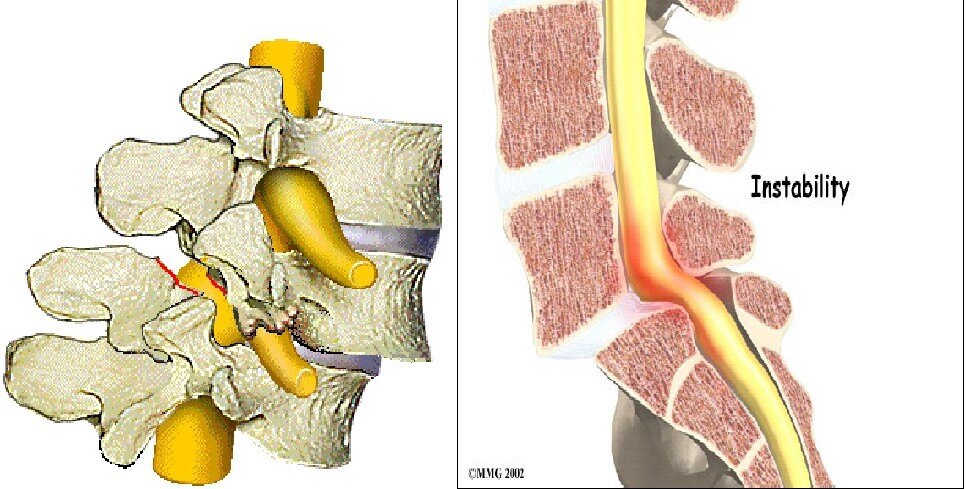 腰椎峡部裂滑脱是什么需要做手术
