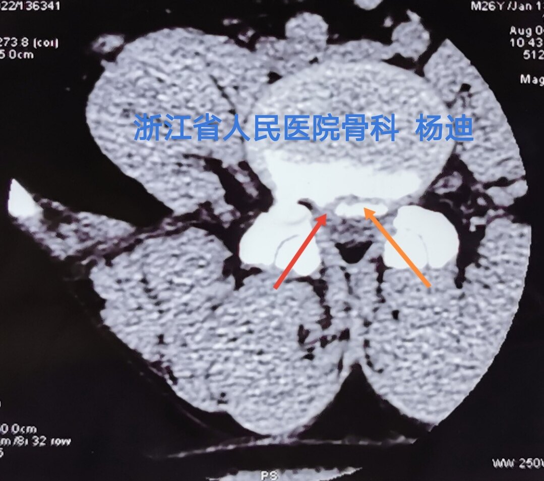 紅色箭頭提示左側椎間盤突出,橙色箭頭提示右側及中央椎間盤鈣化