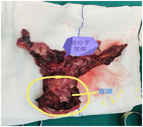 子宫切除残端息肉图片图片