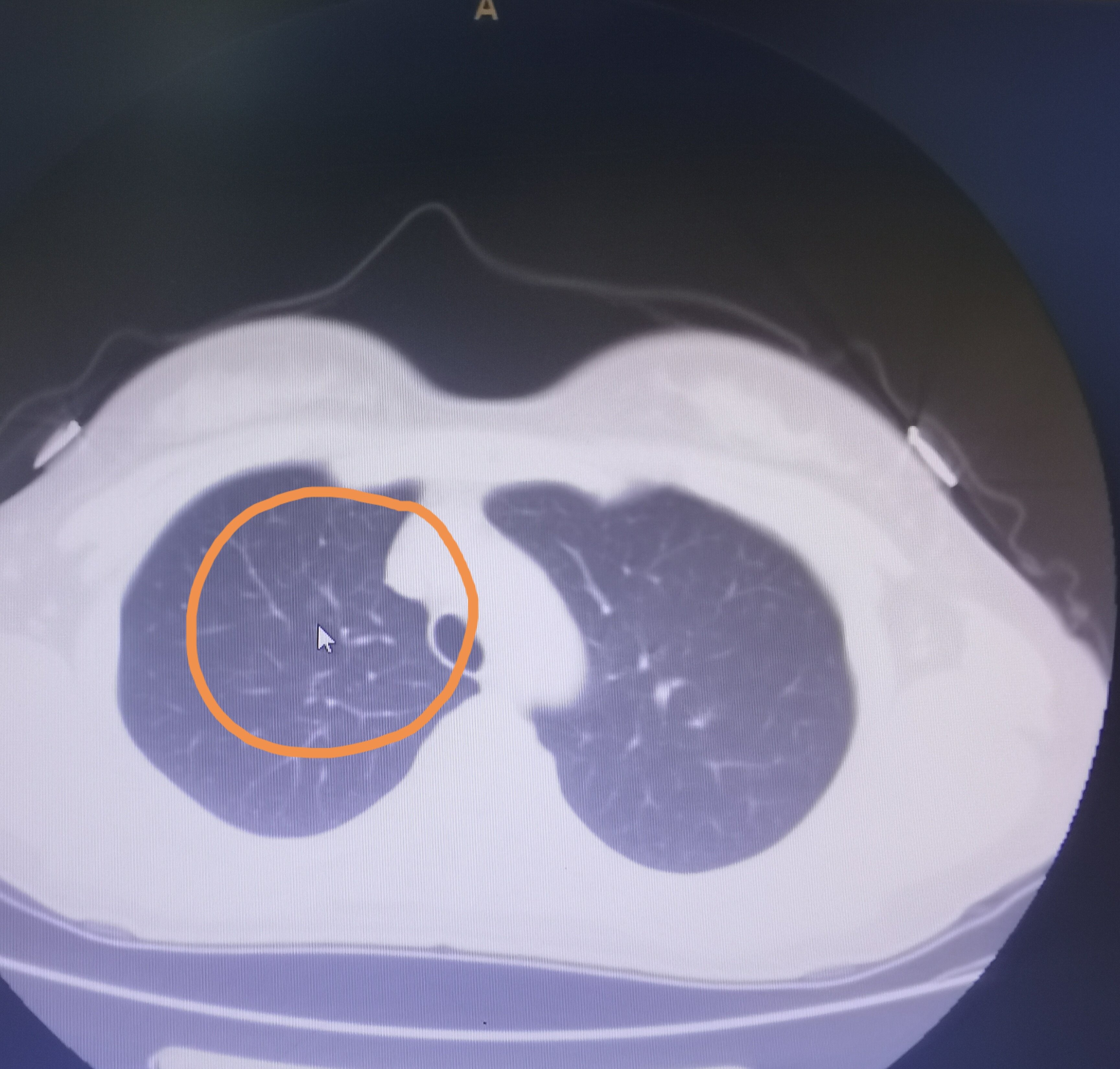 刘懿博士说肺癌(二七亖五)鳞状细胞癌抗原高发现了肺磨玻璃结节