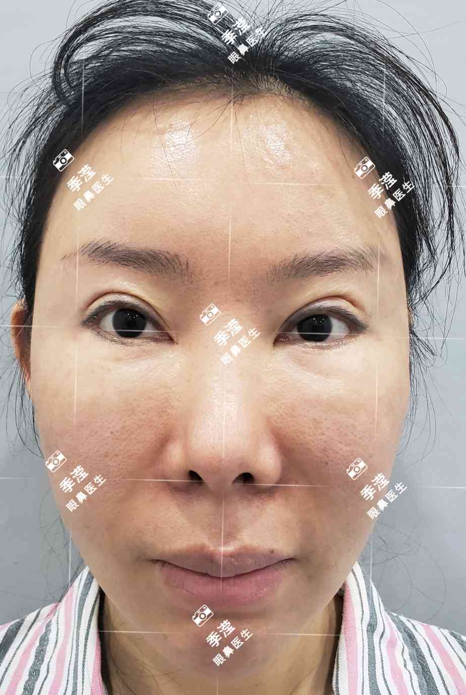 面部过度填充等等后遗症,高位smas拉皮(案例模特,有肖像权)七 - 好