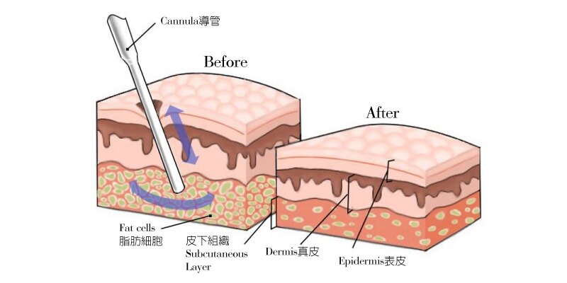 面部吸脂原理图片