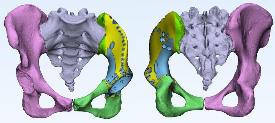 【典型病例】3d打印半骨盆假體用於骨盆i ii區惡性腫瘤切除後的骨缺損