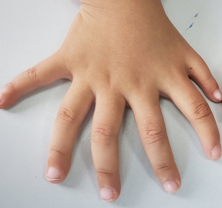 多指畸形哪家医院看的好,治疗多指畸形哪个医生好