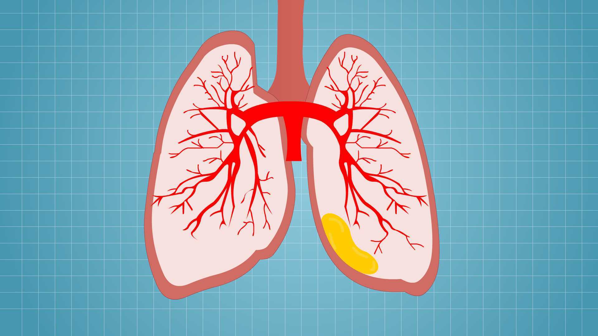 耐药金葡菌,大肠杆菌,绿脓杆菌,真菌等,厌氧菌感染者为腐败性脓胸;(1)