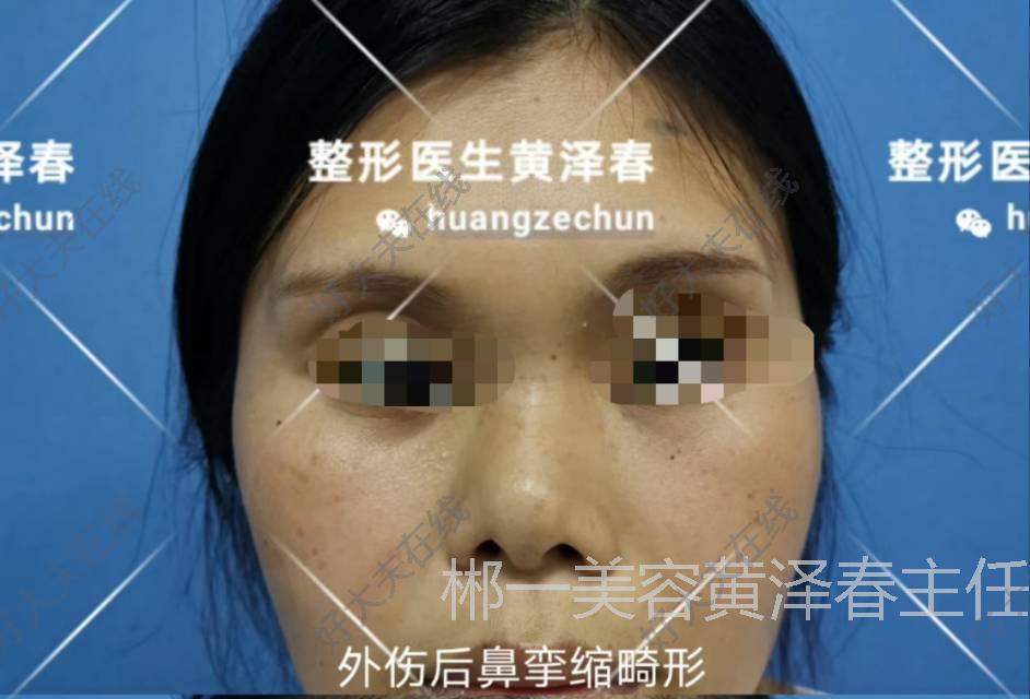 鼻畸形 鼻部整形 鼻畸形 鼻部整形
