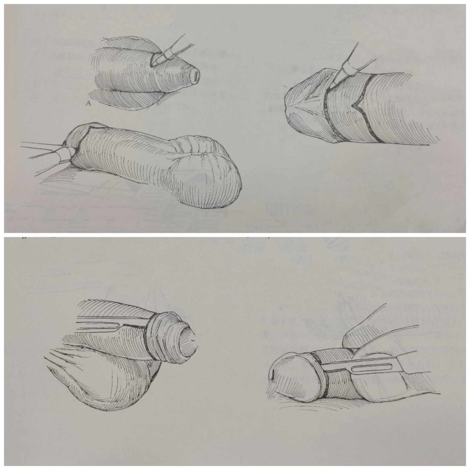 包茎,包皮过长的诊断和治疗_包皮过长_介绍_检查