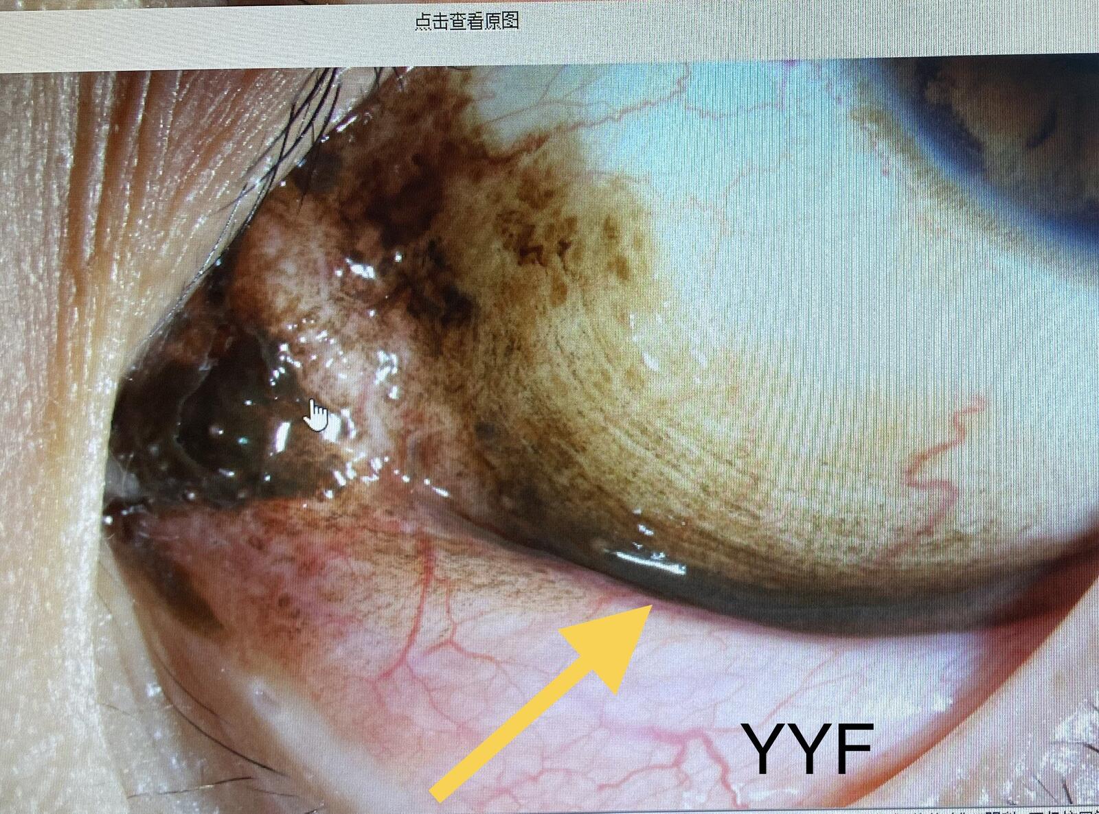 341結膜色素痣還是結膜黑變病表現其實有差別最終確定靠病理