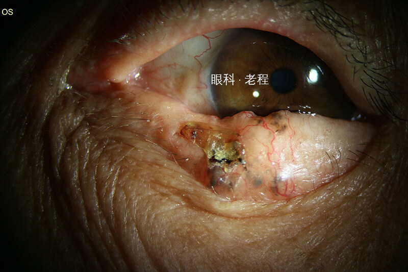 眼瞼惡性腫瘤系列之基底細胞癌