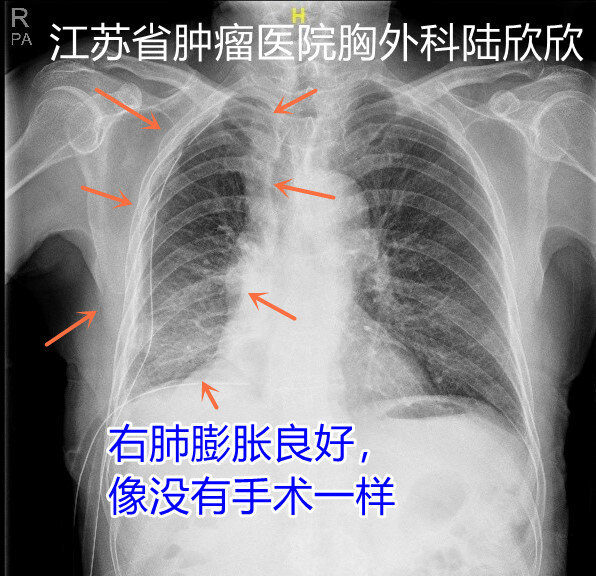 术后胸片正侧位 - 副本.jpg