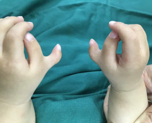 什么是多指畸形?如何治疗?_多指畸形_介绍_治疗方式 - 好大夫在线