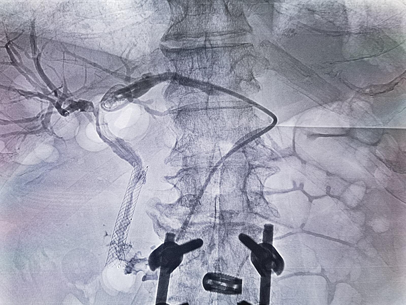 胆管支架手术过程图片
