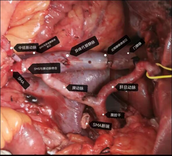 胰腺惡性腫瘤侵犯周圍血管的外科治療方案 - 好大夫在線