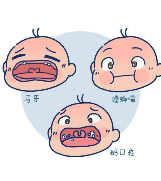 继续查看该图片可能引起不适一些新生儿出生后不久口腔硬腭上会出现