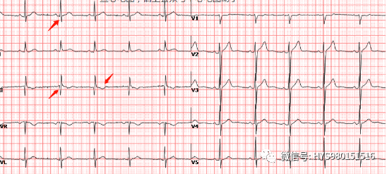 此种典型 ecg 改变,发生机制为急性右室扩张使心脏发生顺钟向转位所致